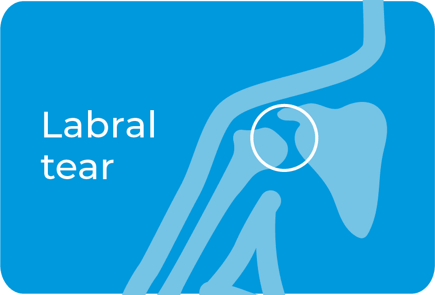 Labral tear
