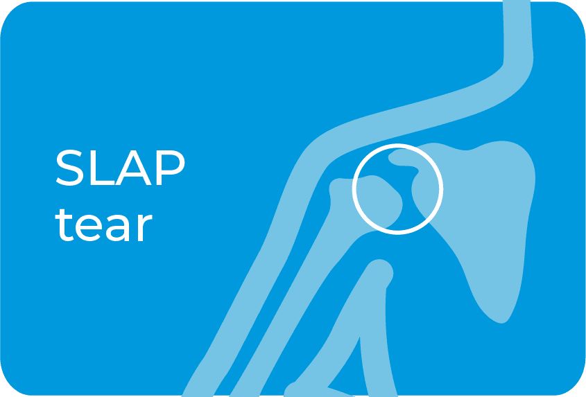 SLAP tear